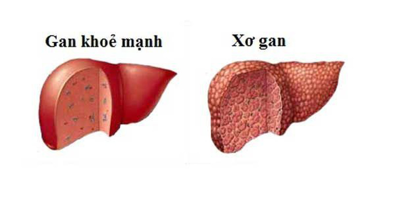 đề gan là gì - Hình 5