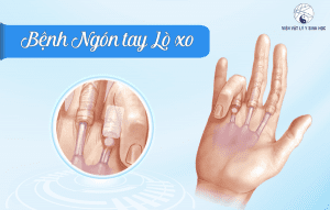 gấp lô là gì
